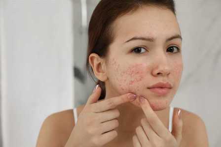 Диета для кожи: какие продукты стоит исключить, чтобы избежать прыщей